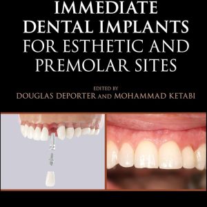 Immediate Dental Implants for Esthetic and Premolar Sites First Edition