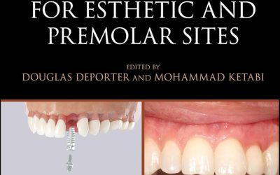 Immediate Dental Implants for Esthetic and Premolar Sites First Edition