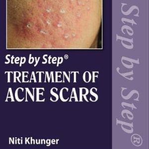Step by Step Treatment of Acne Scars Second Edition