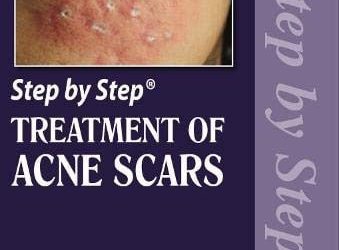 Step by Step Treatment of Acne Scars Second Edition