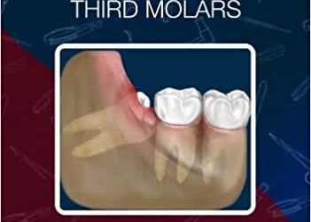 Transalveolar Extraction of the Mandibular Third Molars First Edition