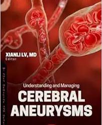 Understanding and Managing Cerebral Aneurysms