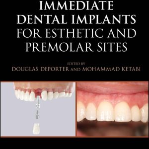 Immediate Dental Implants for Esthetic and Premolar Sites 1st Ed