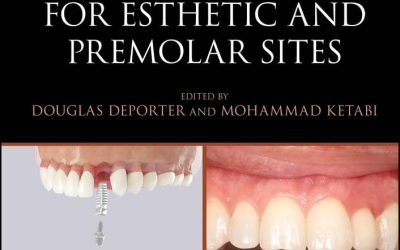 Immediate Dental Implants for Esthetic and Premolar Sites 1st Ed