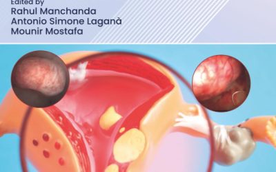 A Complete Guide to Hysteroscopic Myomectomy 1st Edition