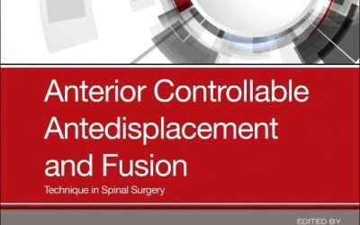 Anterior Controllable Antedisplacement and Fusion: Technique in Spinal Surgery 1st Edition
