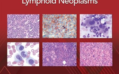 The International Consensus Classification of Myeloid and Lymphoid Neoplasms