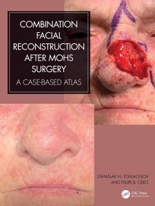 Combination Facial Reconstruction after Mohs Surgery: A Case Based Atlas 1st Edition