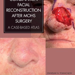 Combination Facial Reconstruction after Mohs Surgery: A Case Based Atlas 1st Edition