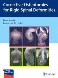 Corrective Osteotomies for Rigid Spinal Deformities First Edition