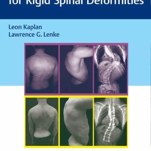 Corrective Osteotomies for Rigid Spinal Deformities First Edition