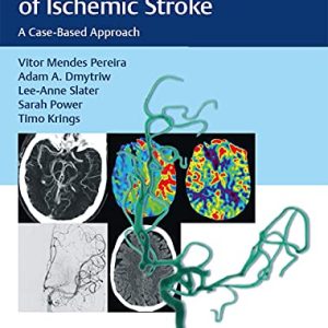 Endovascular Management of Ischemic Stroke: A Case-Based Approach