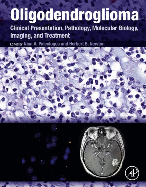 Oligodendroglioma: Clinical Presentation, Pathology, Molecular Biology, Imaging, and Treatment 1st Edition