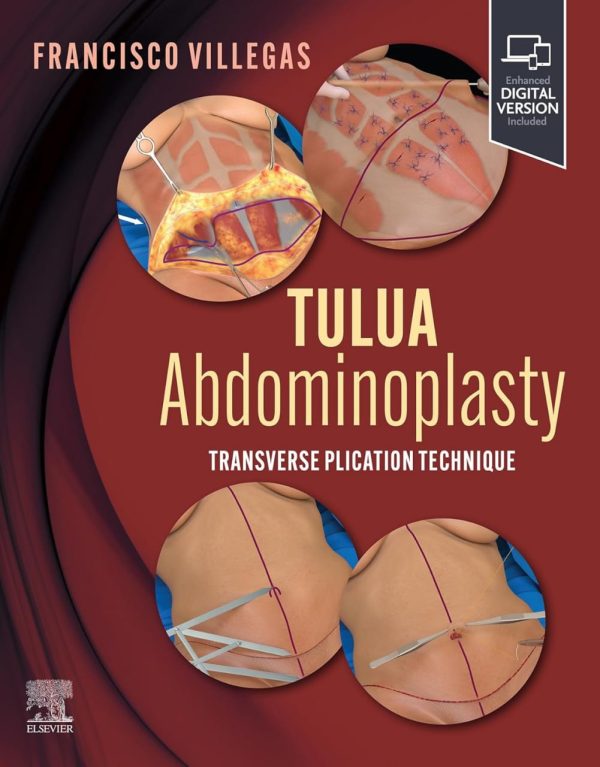 TULUA Abdominoplasty Transverse Plication Technique First Edition