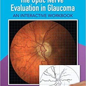 The Optic Nerve Evaluation in Glaucoma:(May 18, 2017)